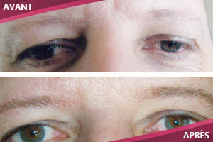 Pigmentation de la ligne des sourcils, alopécie. Maquillage Permanent Johanne Bérubé